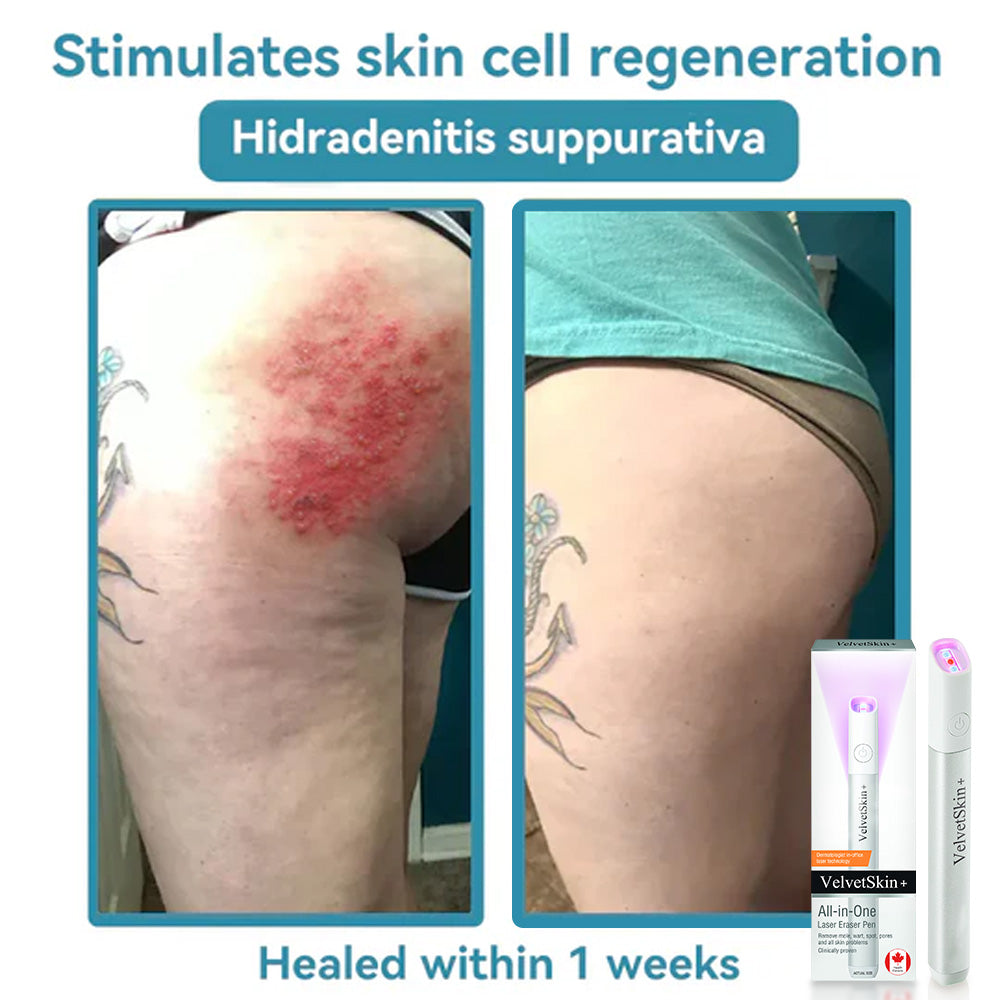 💯ringmiow All-in-One CO₂ Laser Eraser Pen | Removes Moles, Warts, Skin Flaws & Pigmentation