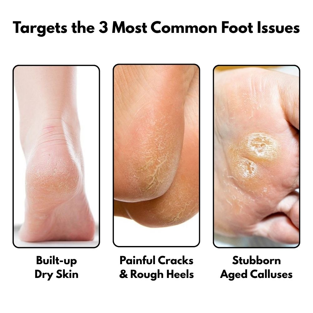 SilkySole Electric Callus Remover